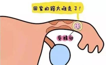 输卵管粘连需要手术吗？